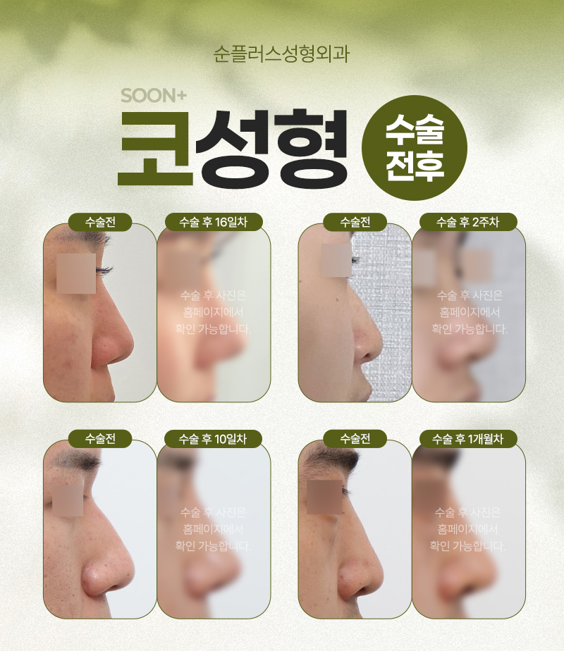 콧대+코끝 개선으로 입체적인 라인의 완성을 위한 코성형수술. 관련 이미지 4