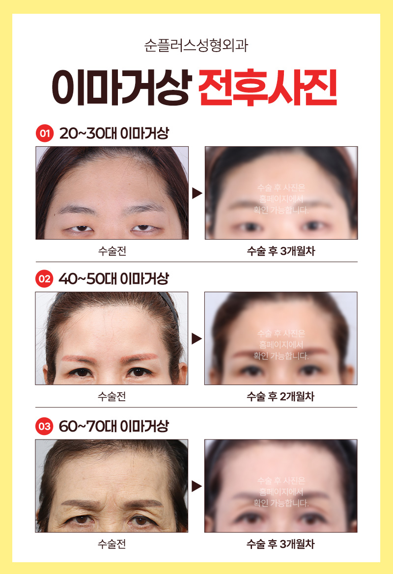 이마,눈매,인상 개선까지 이마거상술의 다양한 효과 관련 이미지 4