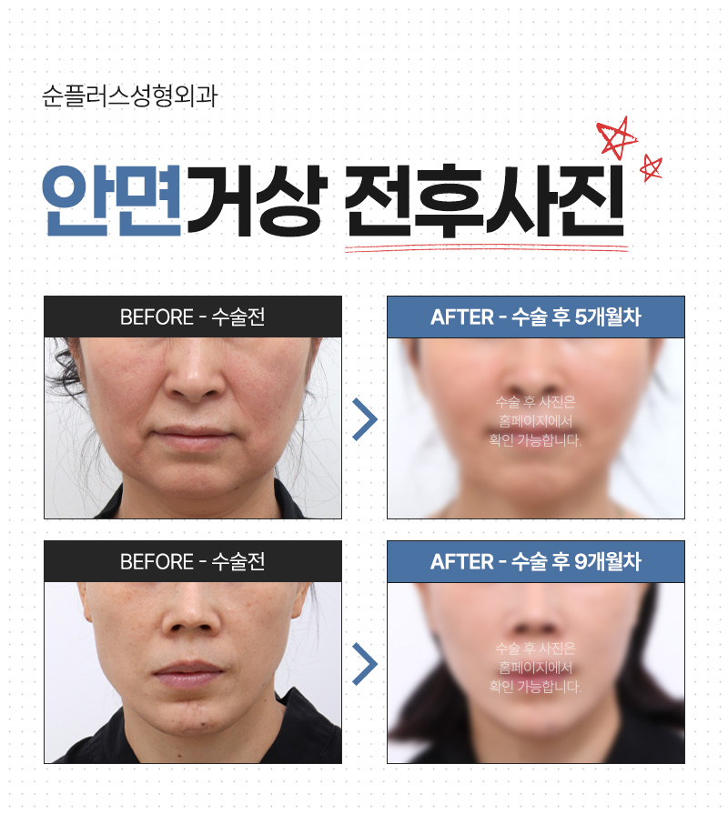 Can a facelift achieve the Brad Pitt youthful effect? image 5