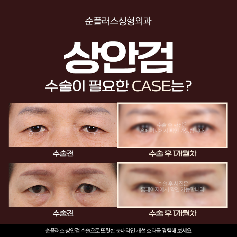 상안검수술 단순 처진눈꺼풀 수술이 아닌 기능과 구조를 파악해 관련 이미지 6