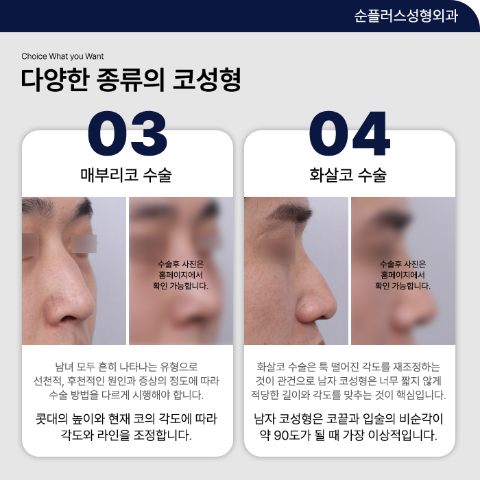 남자코성형잘하는곳 다른 이목구비까지 고려해야 관련 이미지 4
