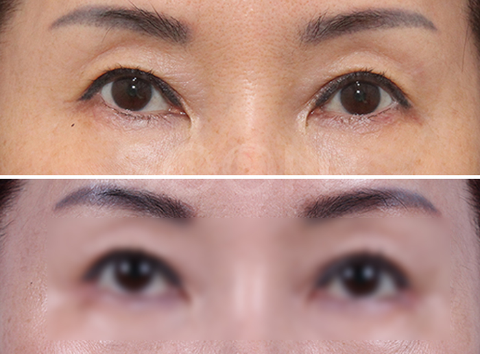 The approach to revision outer corner surgery varies depending on the cause image 2