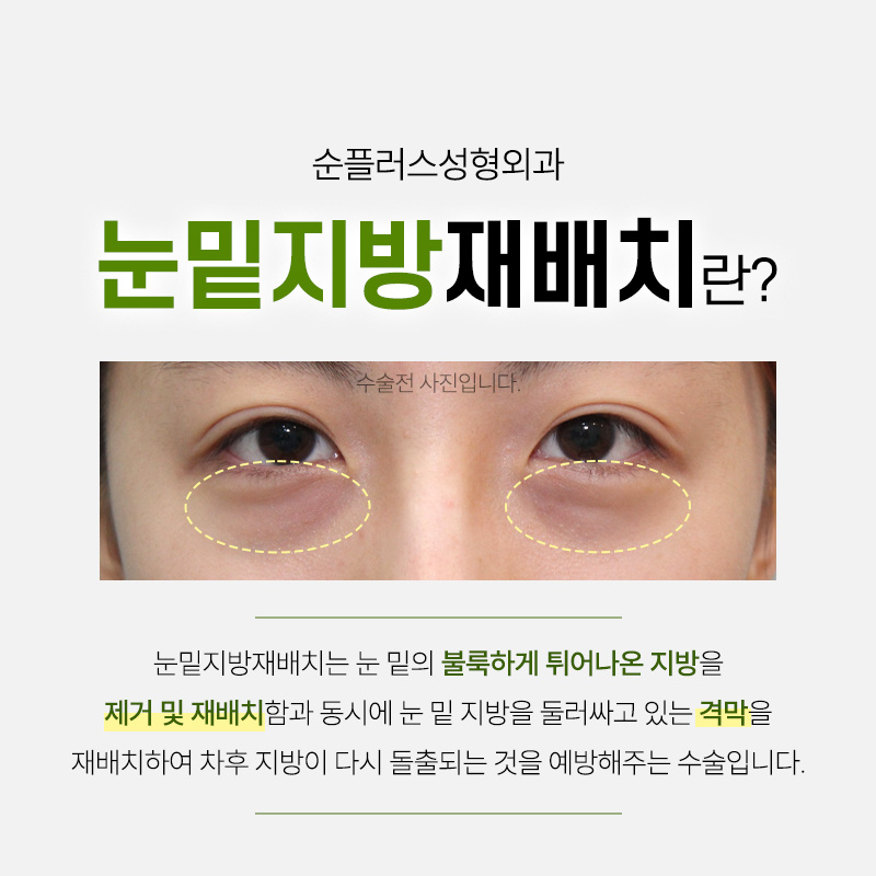Gangnam Under-Eye Fat Repositioning: A Customized Under-Eye Solution That Improves Hollowing, Puffiness, and Shadowing Under the Eyes. image 2