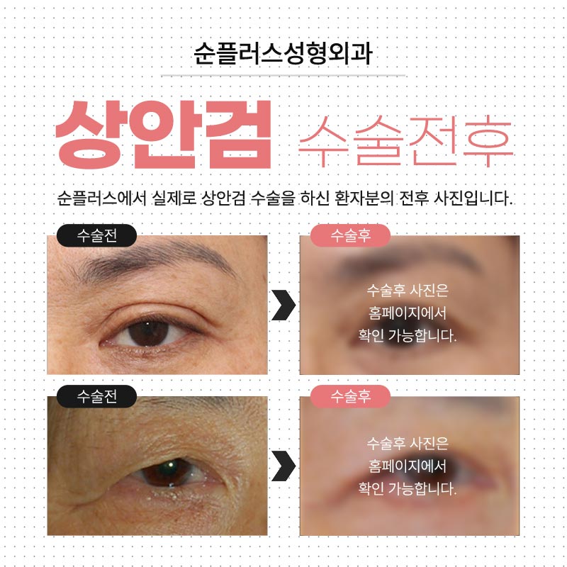 처진눈수술 자연스럽게 또렷해지는 눈매 관련 이미지 6