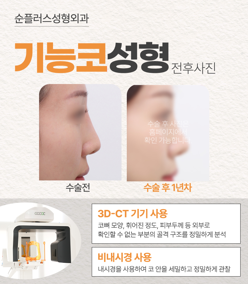 Checking Insurance Coverage for Functional Rhinoplasty, and Confirming Both Aesthetic and Functional Improvement image 8