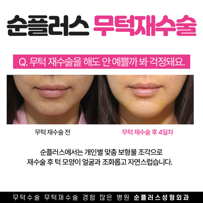 무턱재수술 올바른 위치선정으로 재교정을 관련 이미지 5