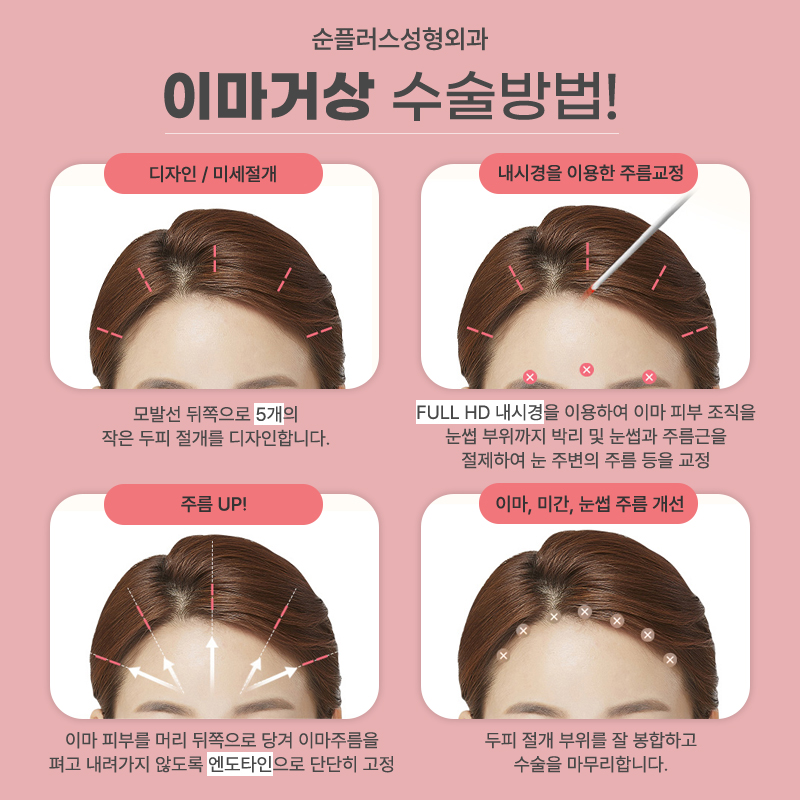 내시경 이마거상술 눈주변 주름개선에도 관련 이미지 5