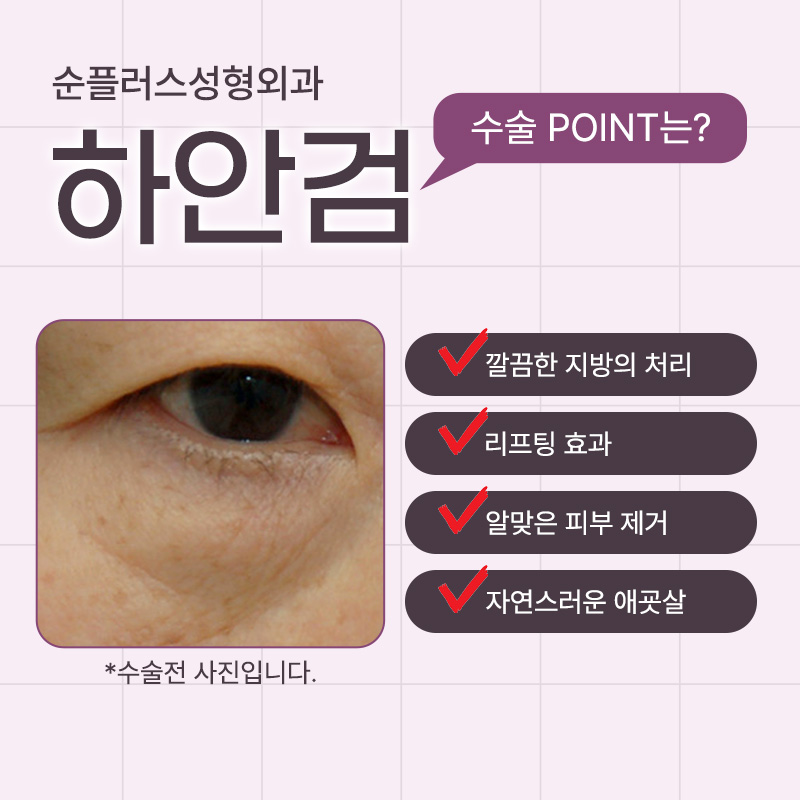 Under-Eye Fat Surgery | Fine lines under the eyes may be caused by fat. image 4