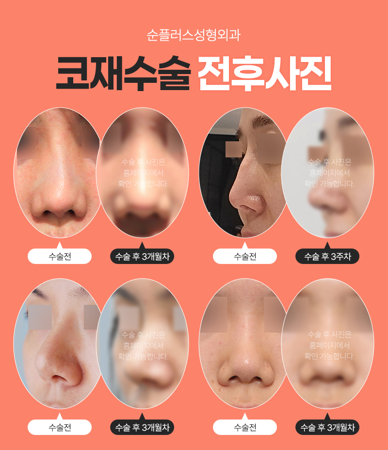 Through Detailed Analysis of Revision Rhinoplasty at Sinsa Station Plastic Surgery image 4