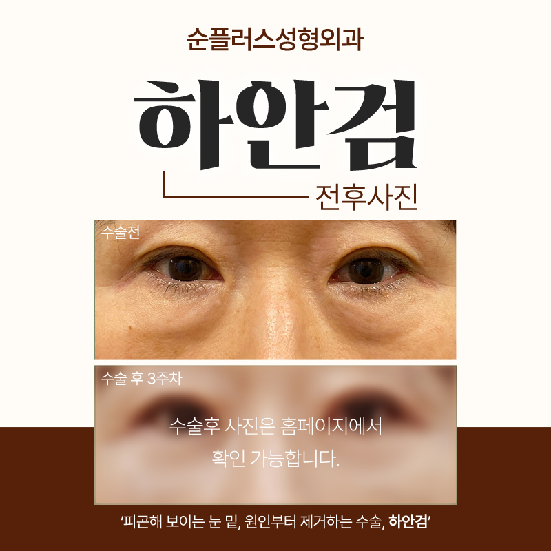 Gangnam under-eye blepharoplasty clinic: improving sagging skin and fat image 6