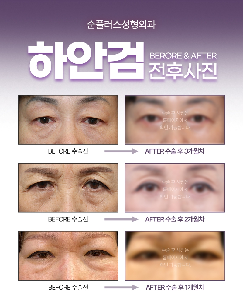 40대 이상 눈밑지방과 처진피부, 하안검으로 매끄럽게 관련 이미지 3