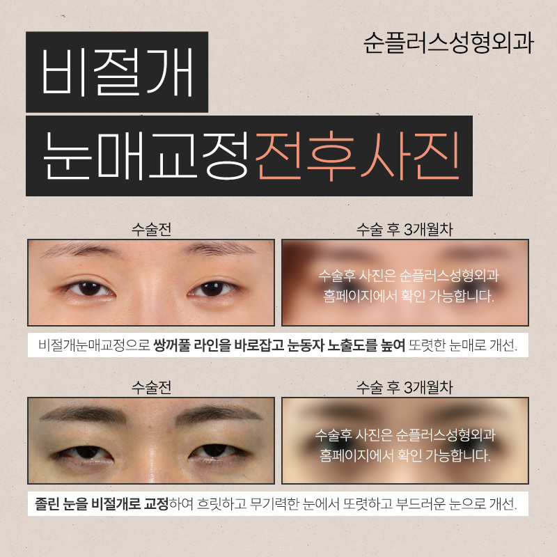 비절개눈매교정 전후 후기 다양한 케이스 확인하며 관련 이미지 5
