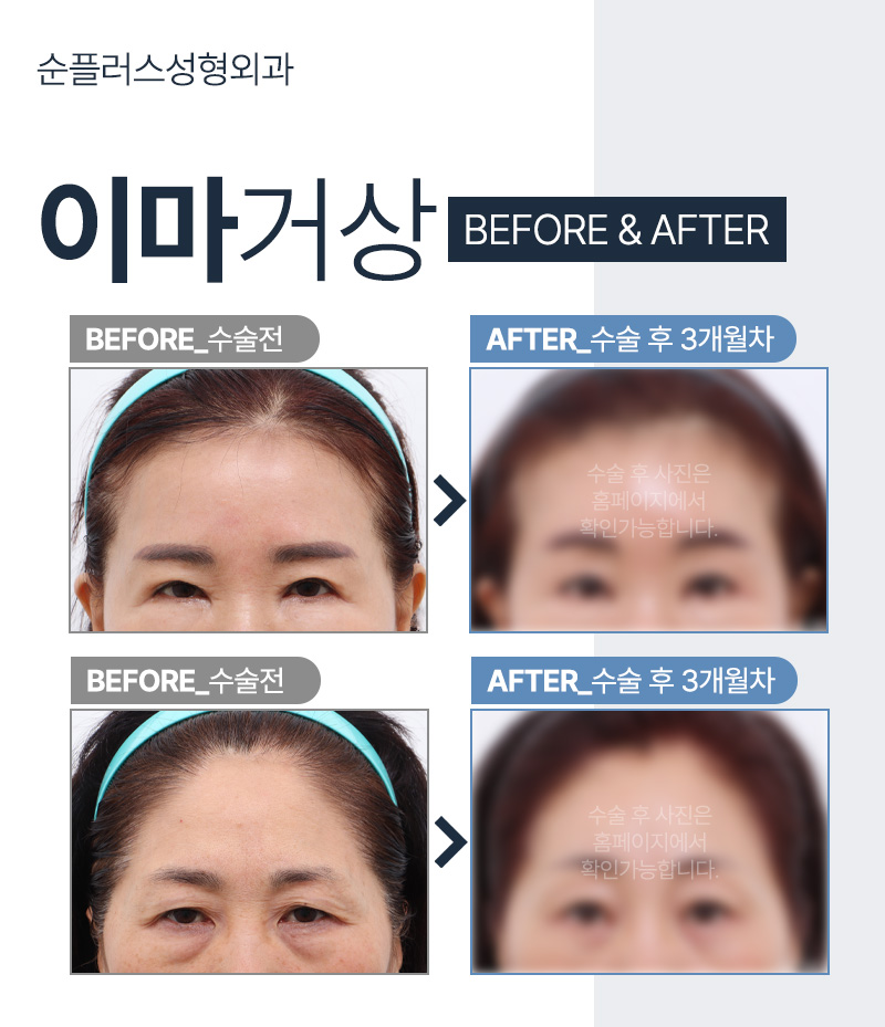 내시경이마거상 잘하는곳 눈성형의 효과까지 관련 이미지 6
