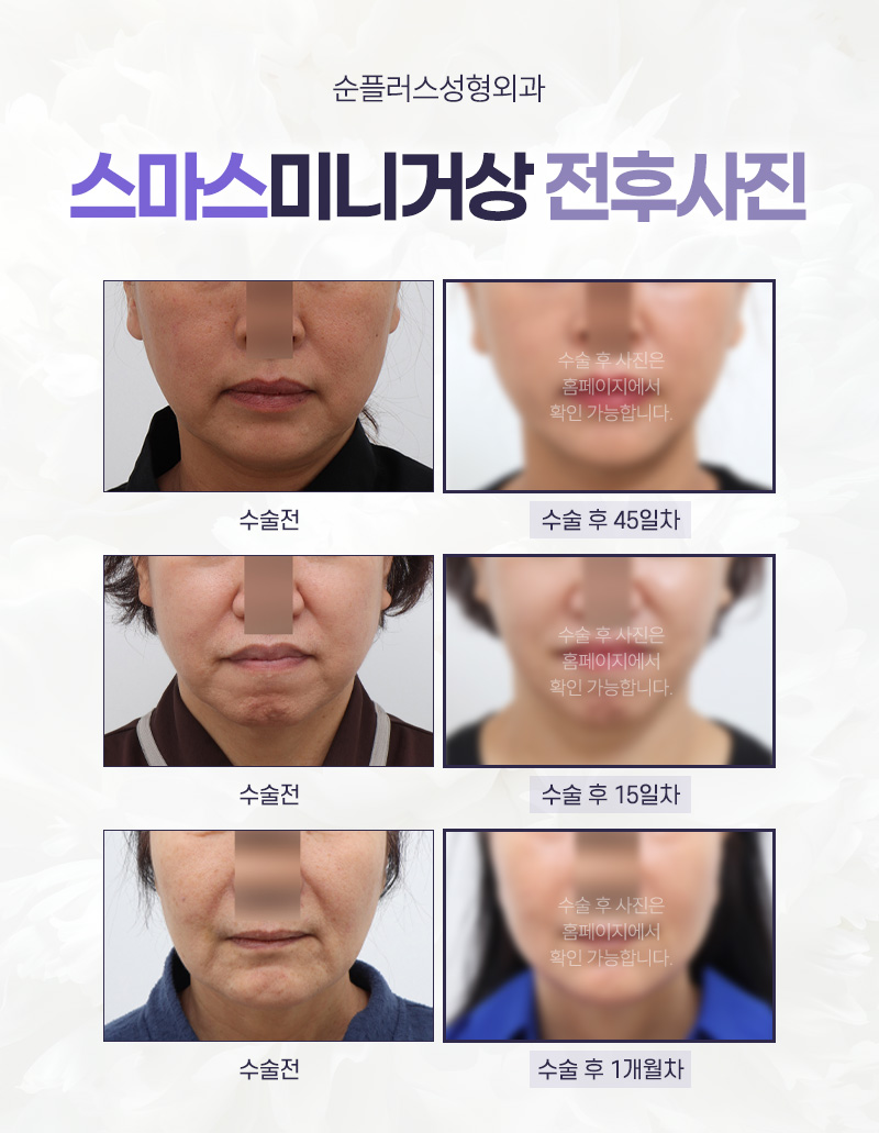 스마스미니거상 처짐의 원인을 찾아 관련 이미지 4