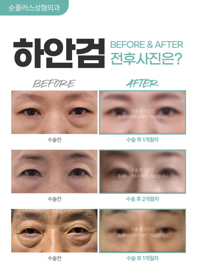 Why Lower Blepharoplasty Is Needed for Middle-Aged Eye Surgery image 4