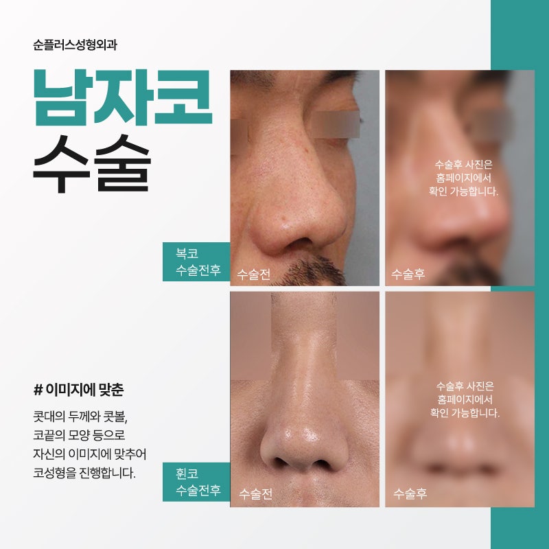 남자코성형가격 면밀하게 따져가며 관련 이미지 5