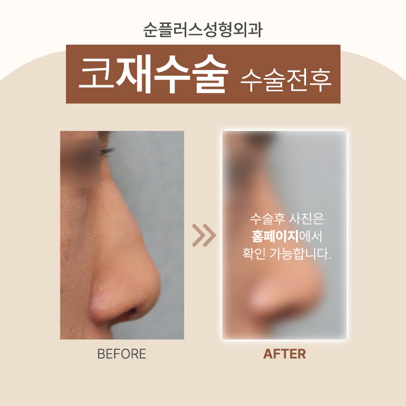 코재수술성형외과 비율과 균형을 고려해 관련 이미지 7