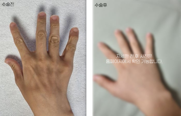 A lively effect for dry, wrinkled backs of the hands with fat grafting image 9