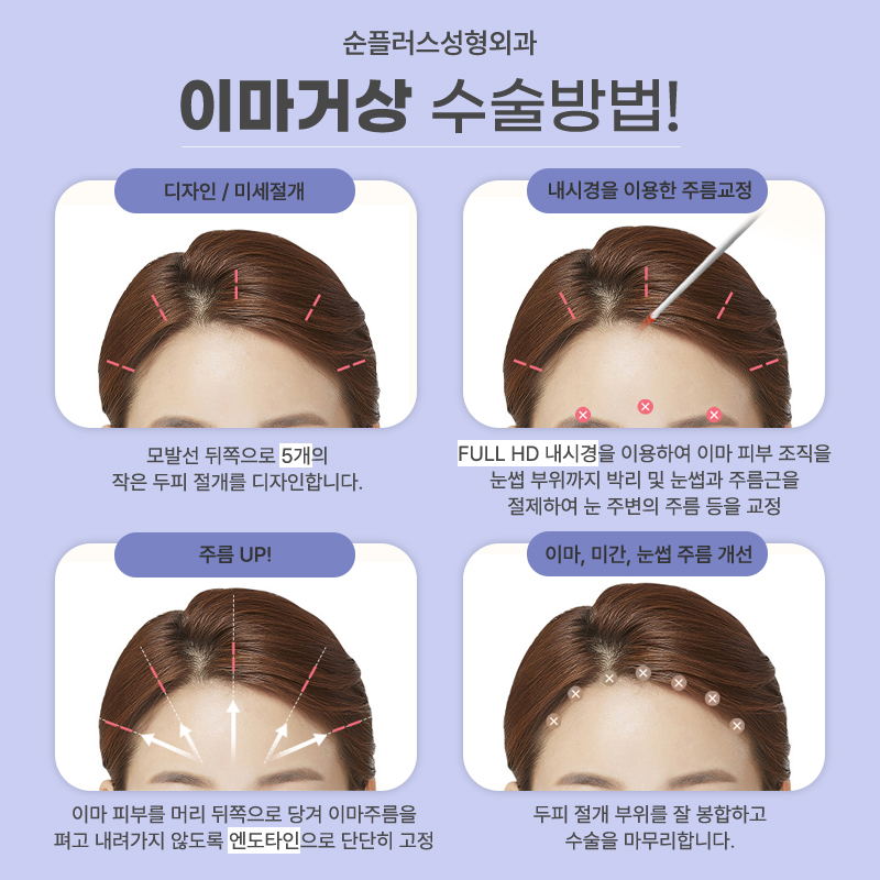 Gangnam Forehead Lift: Pulling the Forehead Skin Also Affects the Eye Area image 5
