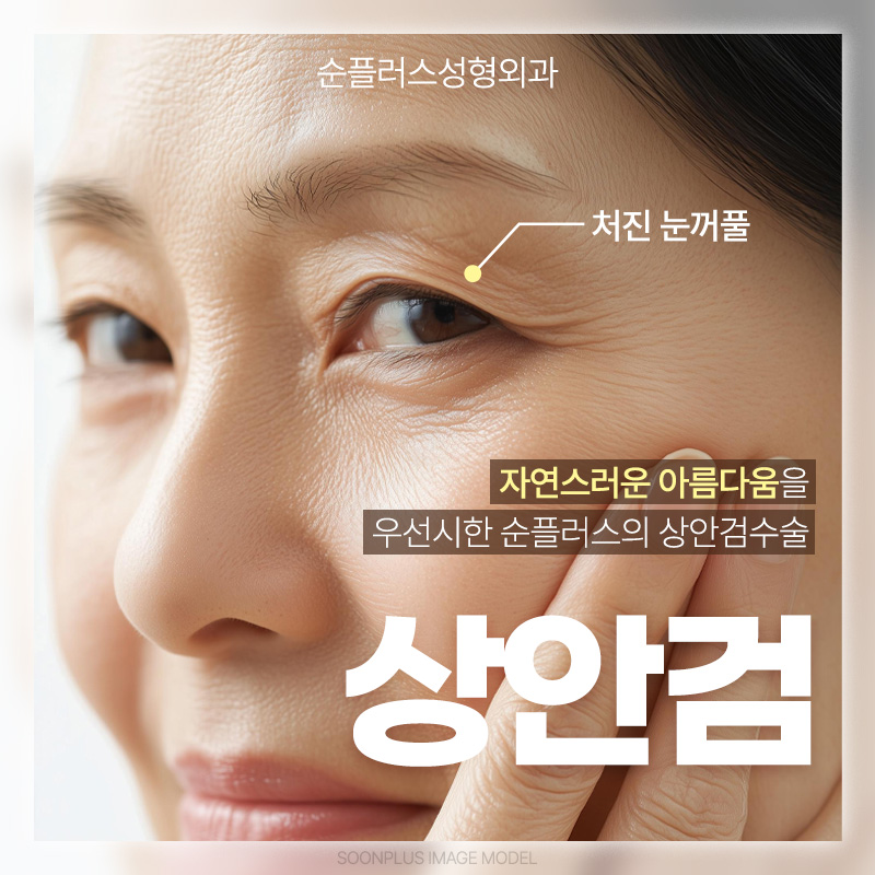 How Long Is the Recovery Period, Including Upper Blepharoplasty Swelling? image 1