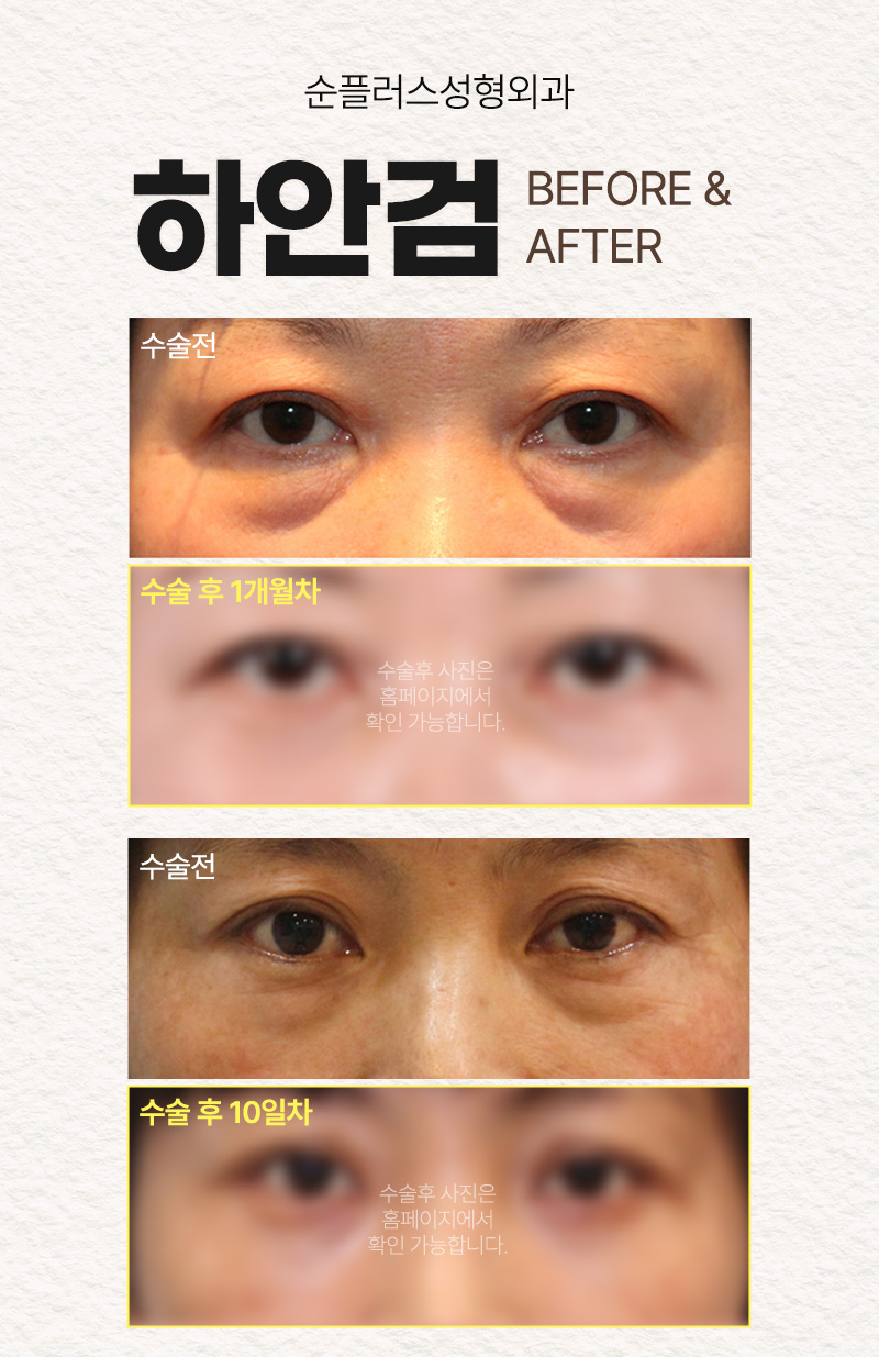 눈밑 하안검수술 회복기간 흉터도 찾아봐야 관련 이미지 5