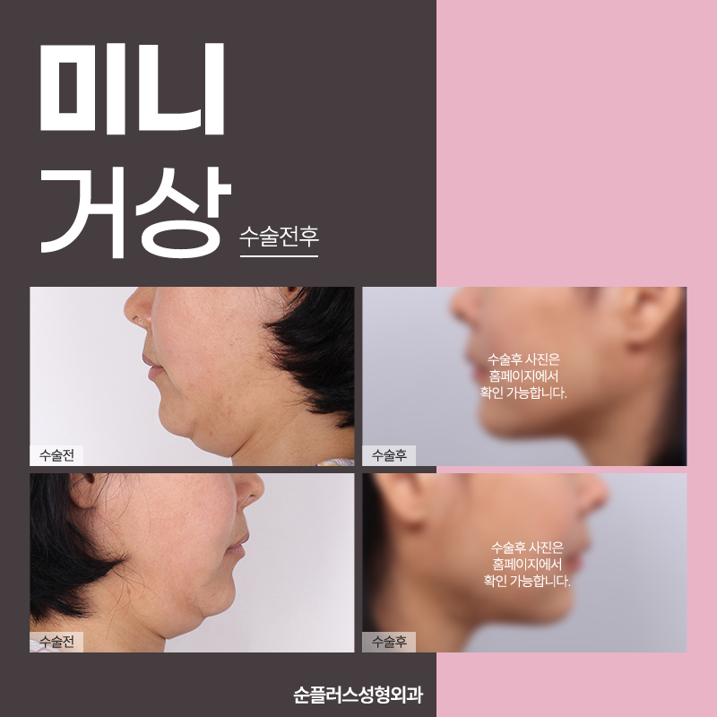 미니안면거상 추천대상과 효과는? 관련 이미지 6