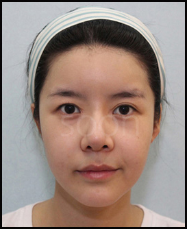 내 눈은 뒤트임 효과를 볼 수 있을까? 눈의 형태에 따라 뒤트임 효과는 달라질 수 있습니다. 관련 이미지 3