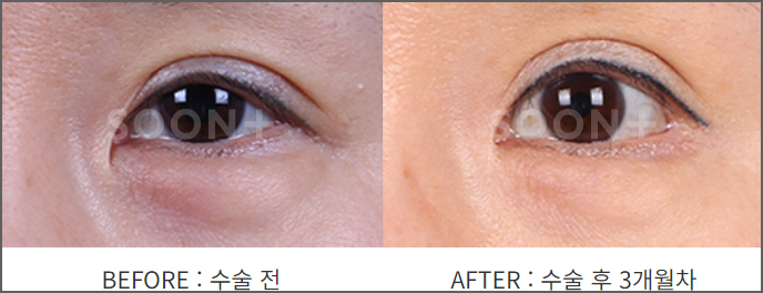 몽고주름으로 답답한 눈매, 부자연스러운 쌍꺼풀라인 개선 위한다면 올바른 앞트임 방법으로 관련 이미지 3