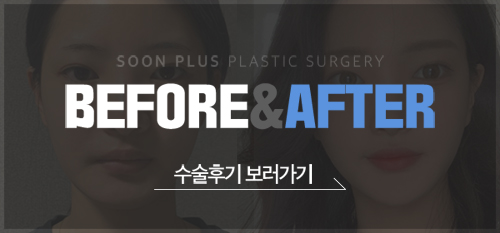 젊은층부터 중년까지 팔자고민엔 귀족수술 관련 이미지 9