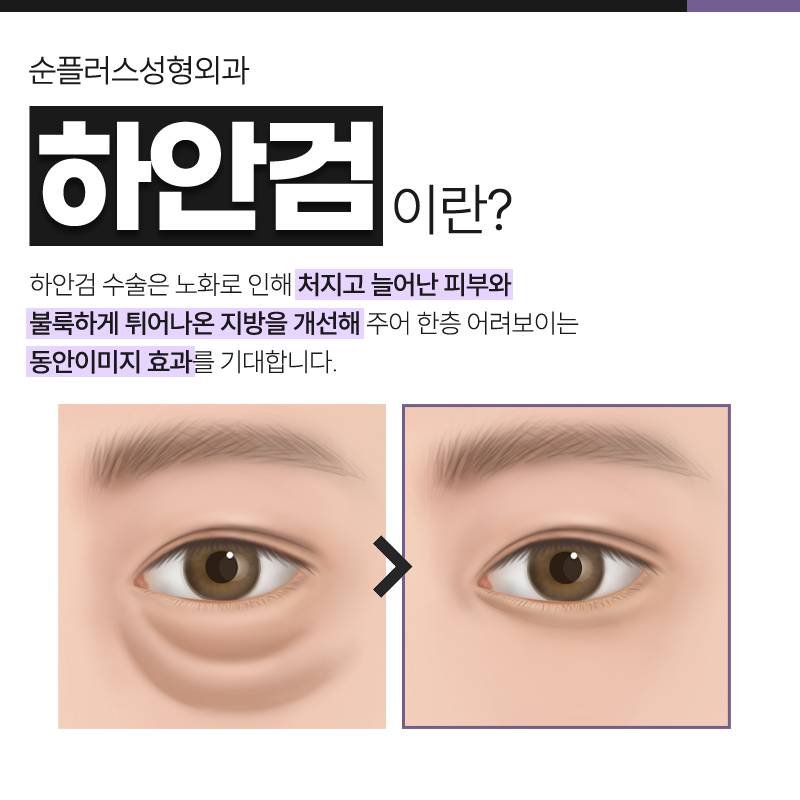 Appropriate Midlife Lower Eyelid Surgery with the Right Surgical Method image 2