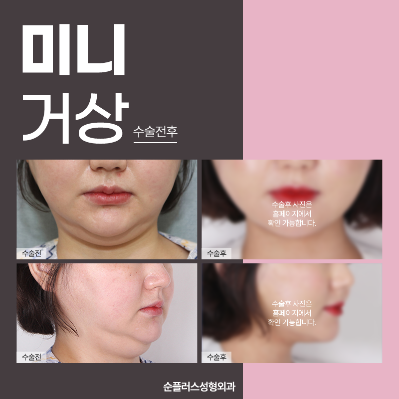 미니안면거상 추천대상과 효과는? 관련 이미지 5