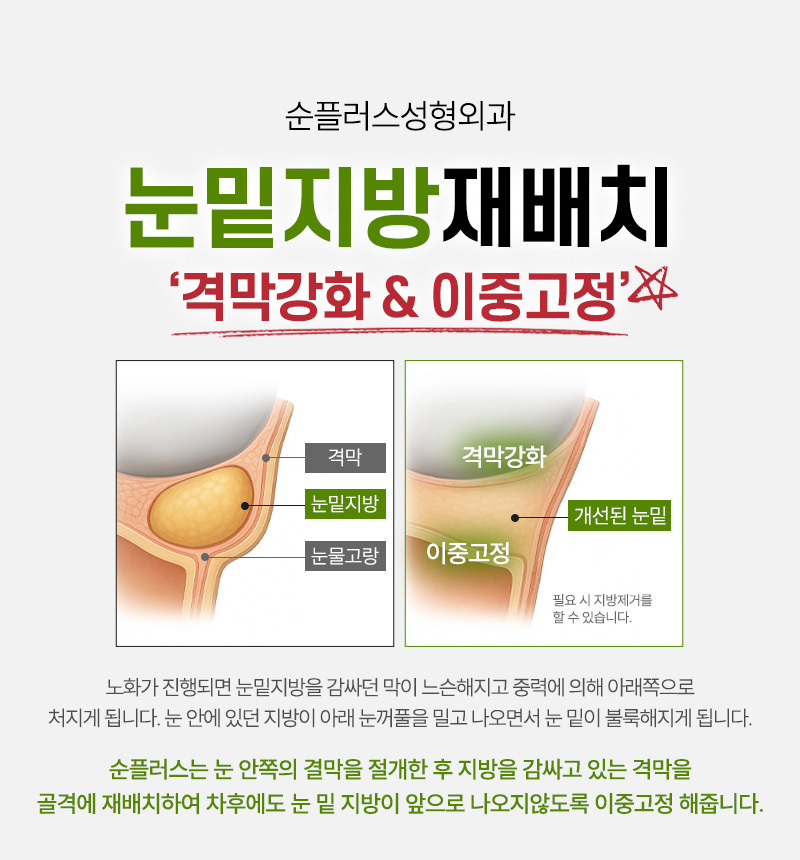 Gangnam Under-Eye Fat Repositioning: A Customized Under-Eye Solution That Improves Hollowing, Puffiness, and Shadowing Under the Eyes. image 4