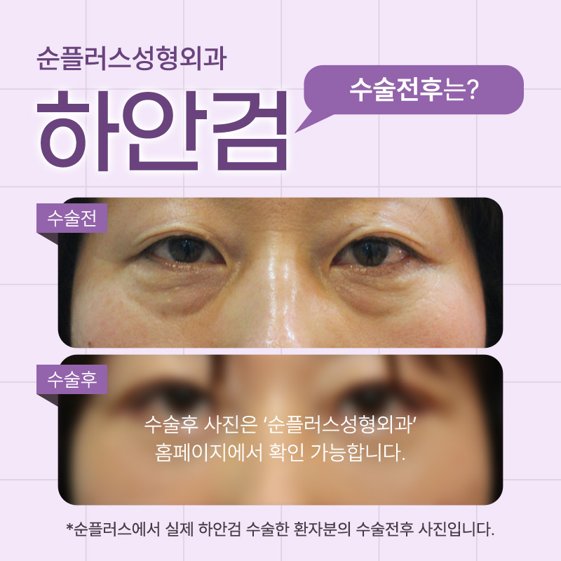 하안검 수술, 눈 밑 노화의 해답일까? 관련 이미지 5