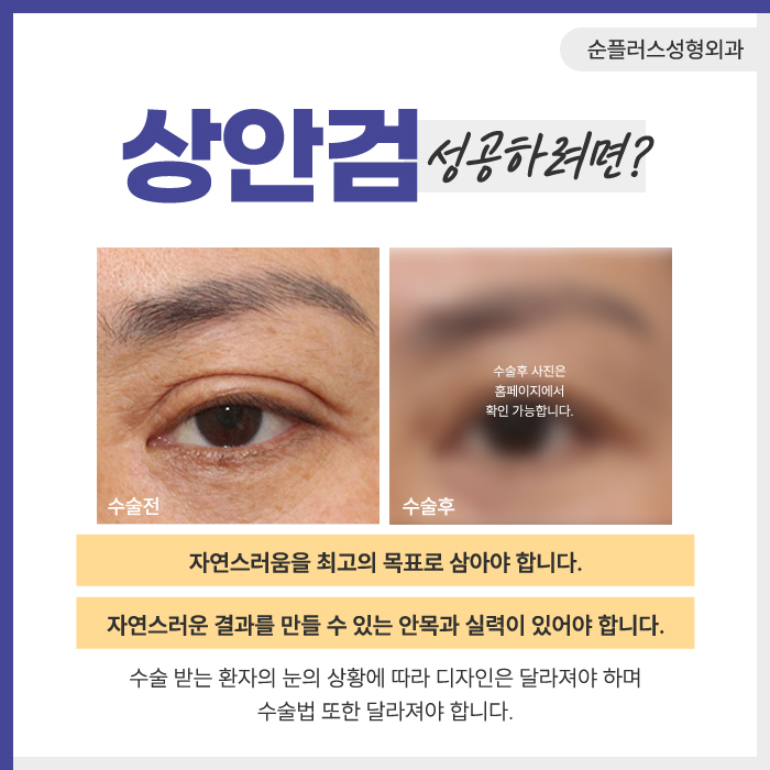 상안검수술 효과 눈꺼풀이 처졌을때 관련 이미지 5