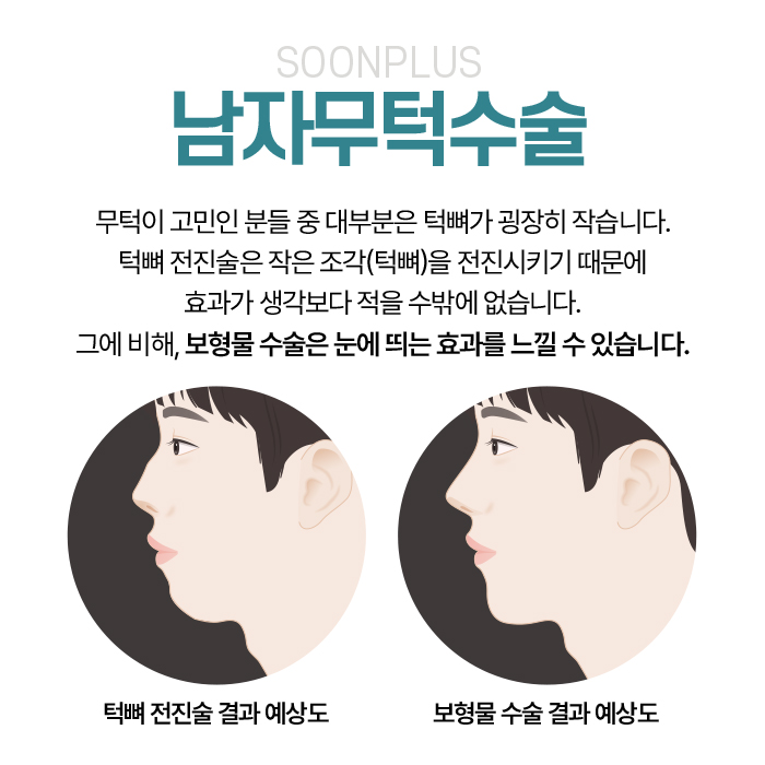 Male Receding Chin Surgery: When Chin Tip Volume Changes image 3
