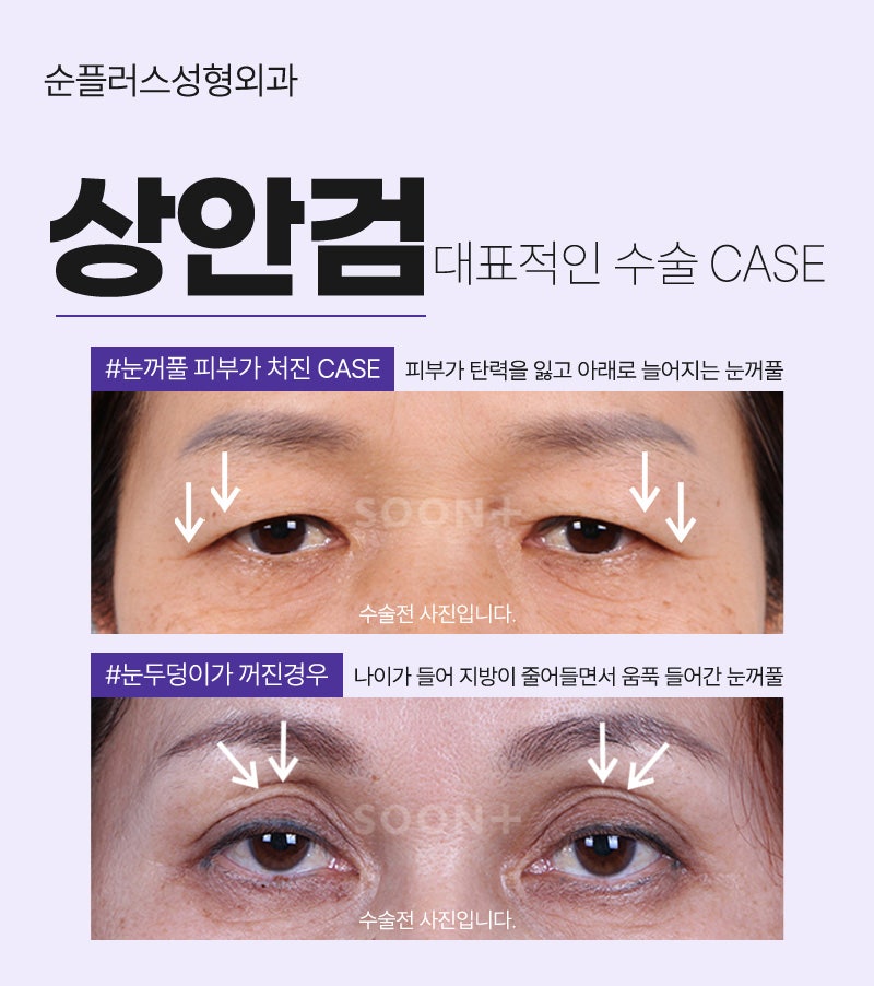 눈처짐으로 인한 중년눈성형 상안검으로 자연스러운 또렷함 추가 관련 이미지 3