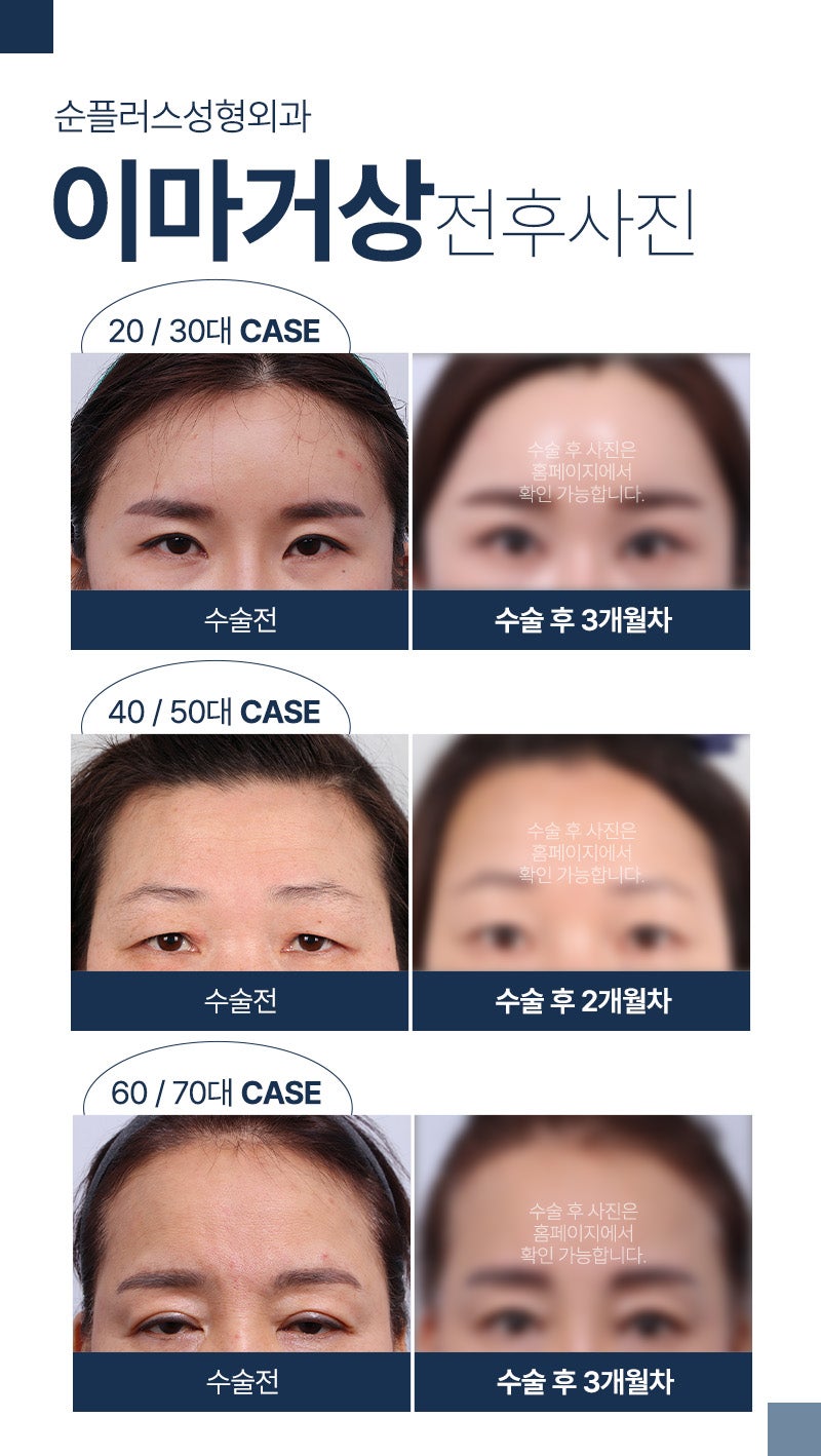 Will the forehead become wider after forehead lift surgery? How is it fixed? image 5