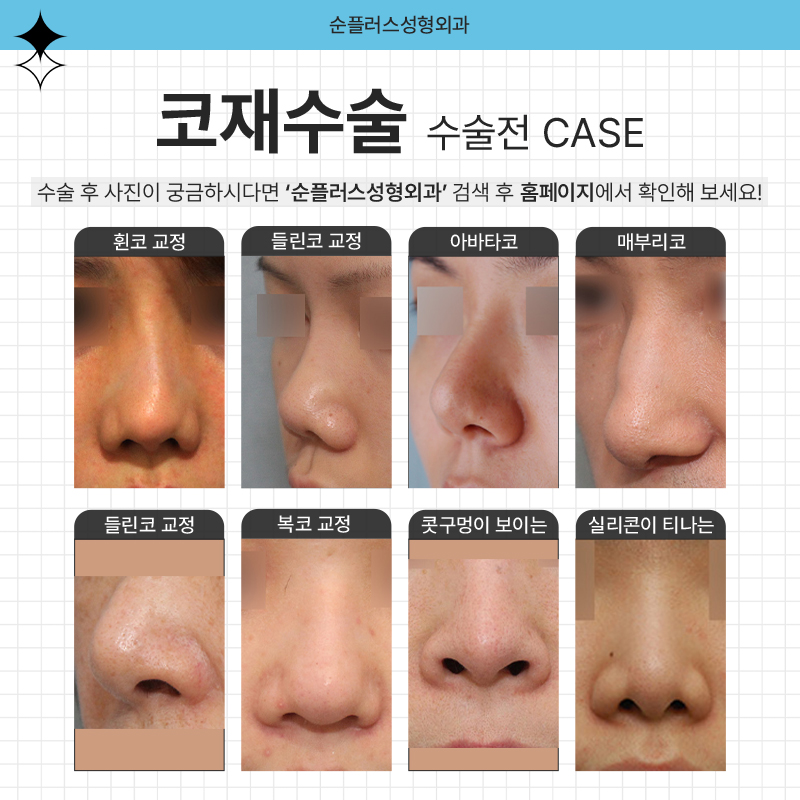 여자코재수술 이해도가 높은 곳에서 관련 이미지 4
