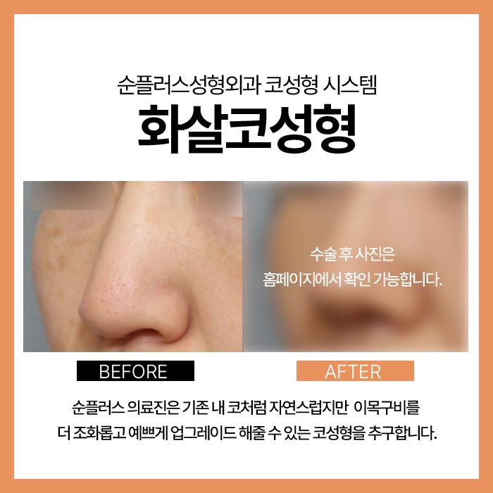 Arrow Nose Surgery for Balanced, Harmonious Results image 3
