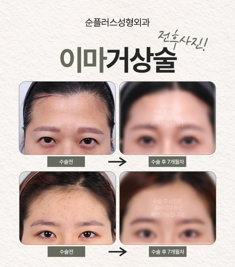 Is Endotine Fixation Forehead Lifting Different? [Soonplus Director Lim Jong-min] image 5