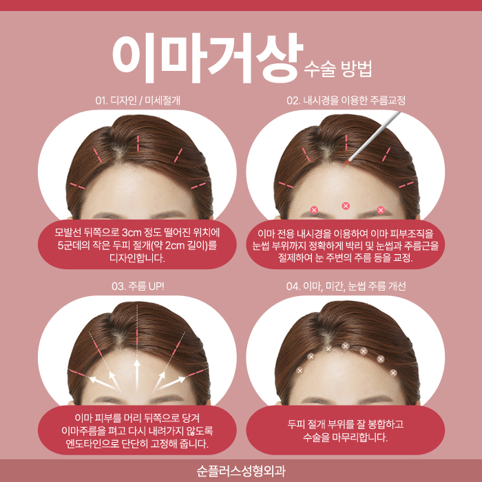 이마주름수술 자연스러운 개선방안을 위해 관련 이미지 4