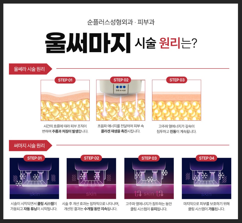 처진 피부에 리프팅 효과와 콜라겐 재생으로 타이트닝 효과를 동시에 울써마지 (울쎄라+써마지) 관련 이미지 3