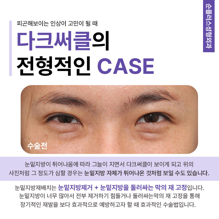 Improving Bumpy Under-Eye Contours Caused by Hollowing and Fat Bulging Through Under-Eye Fat Surgery image 3