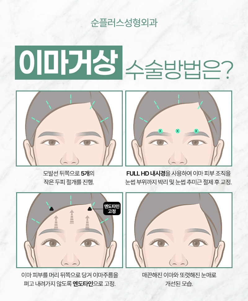 Learn About the Effects and Price of Endoscopic Forehead Lift Surgery. image 5
