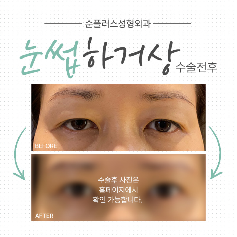 [눈썹거상수술] 눈과 눈썹 거리가 먼 경우, 눈꺼풀이 처졌을때 관련 이미지 7