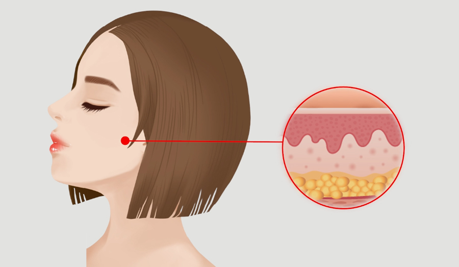 윤곽수술 후 리프팅 혹은 살처짐 개선 리프팅 방법은 관련 이미지 3