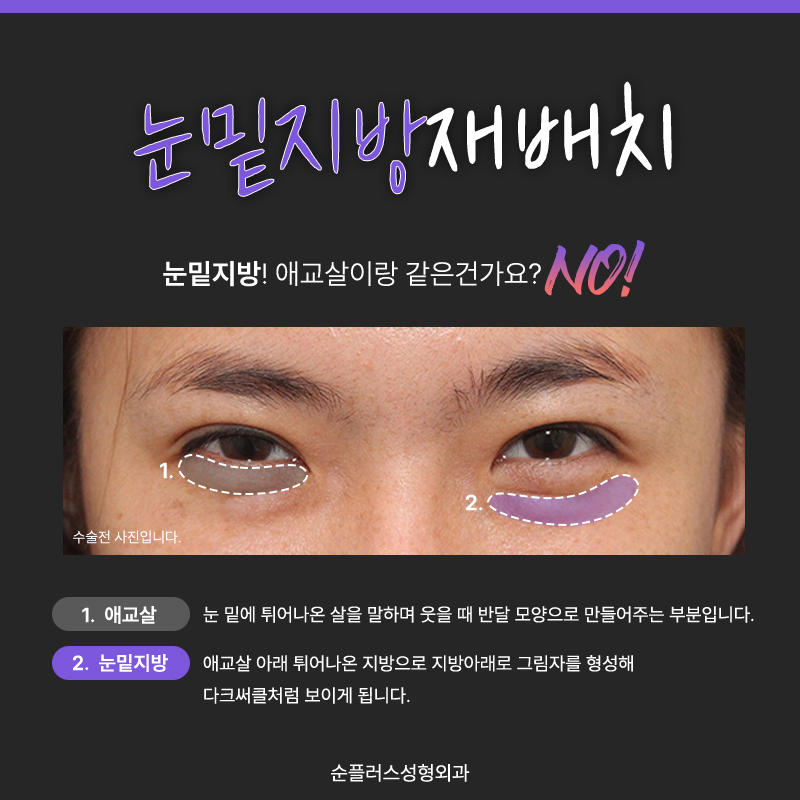 Lower Eyelid Fat Surgery Cost: If Bumpy Under-Eyes Are a Concern image 3