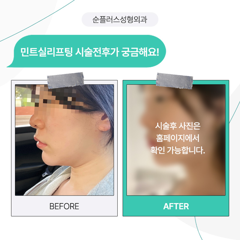 실리프팅잘하는곳 효과, 주의사항 까지 관련 이미지 5