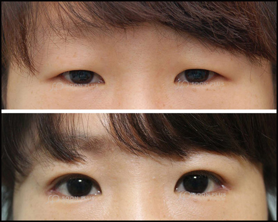 내 눈은 뒤트임 효과를 볼 수 있을까? 눈의 형태에 따라 뒤트임 효과는 달라질 수 있습니다. 관련 이미지 13