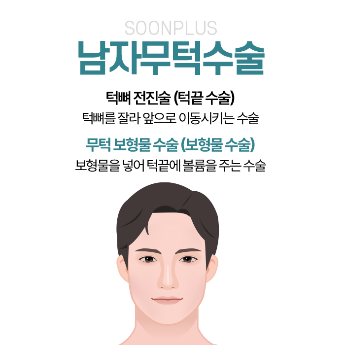 Male Receding Chin Surgery: When Chin Tip Volume Changes image 2
